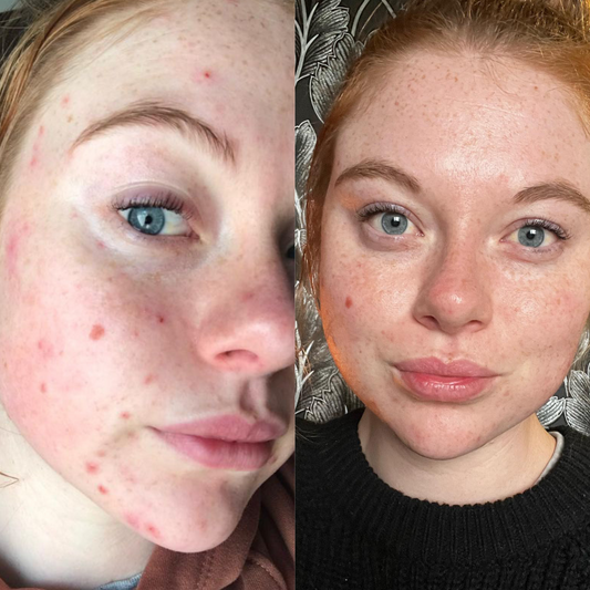 Before and after results showing clearer skin and reduced redness with Earthwoven Starter Kit, featuring Gentle Foaming Cleanser, Calming Spritz Toner, and Soft Hydrating Moisturiser