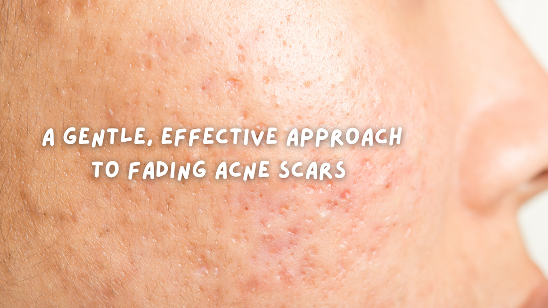 A Gentle, Effective Approach to Fading Acne Scars
